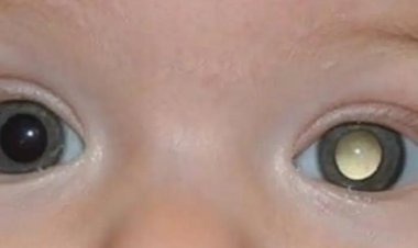 Hospital de Câncer de Mato Grosso Apoia Campanha Nacional de Conscientização sobre Retinoblastoma