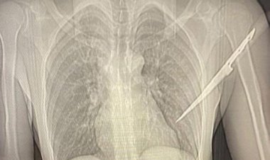 Após agressão, mulher 'crava' faca nas costas de companheiro em Querência