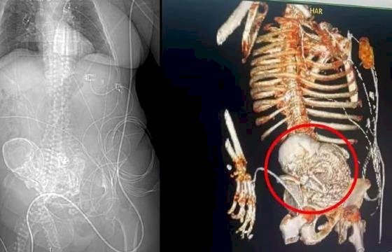 Idosa descobre que carregou “feto de pedra” por mais de 50 anos e morre após cirurgia de retirada